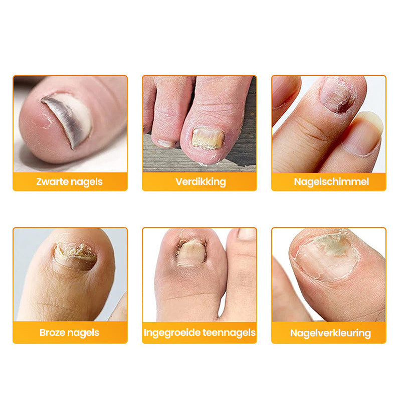 SchimmelStop Pleister – Sterke nagels, zonder gedoe