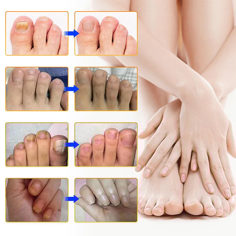 SchimmelStop Pleister – Sterke nagels, zonder gedoe