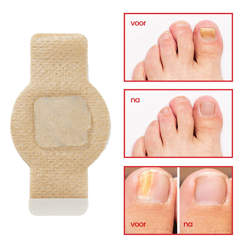 SchimmelStop Pleister – Sterke nagels, zonder gedoe